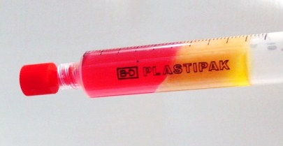 lipofilling, grasso, riempitivi, chirurgia, filler