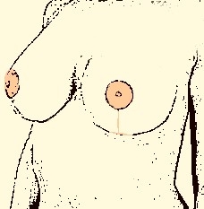 riduttiva, mastoplastica, estetica, plastica, seno